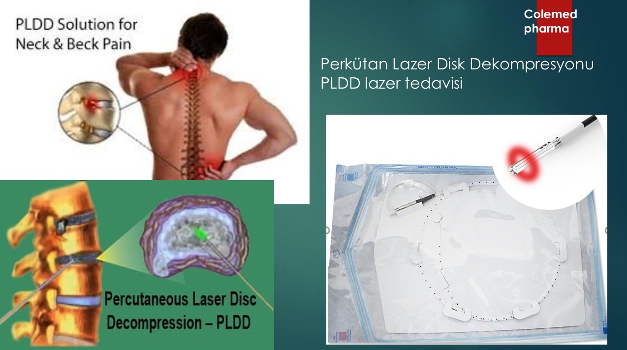 PLDD – Perkütan Lazer Disk Dekompresyonu Uygulamaları için Lazer Başlığı
