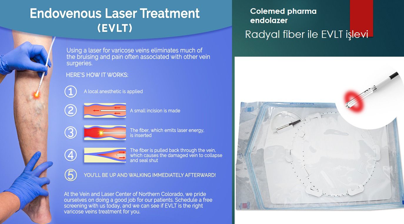 Vasküler Uygulamalar için 1470 nm Radyal Fiber