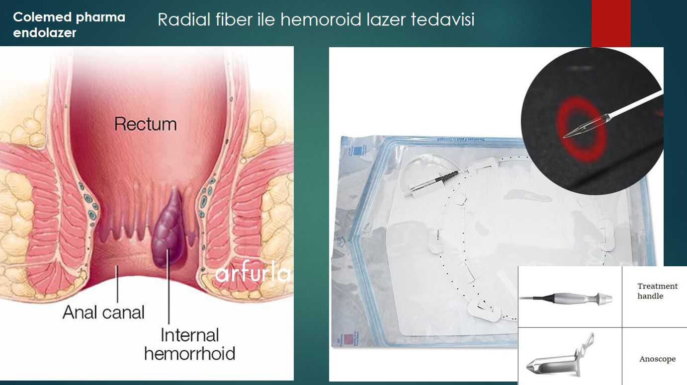 Proktoloji (Anal ve Rektal Bölge) Uygulamaları için Lazer Başlığı